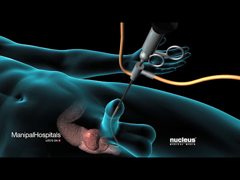 Strategies for removing prostatic glands | TURP Surgery | Prostate Removal Surgery - Manipal
