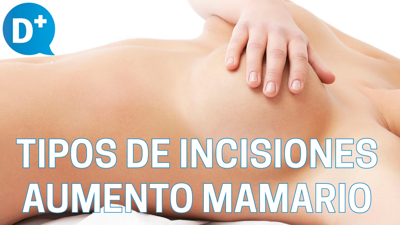 Tipos de incisiones en la intervención de aumento mamario