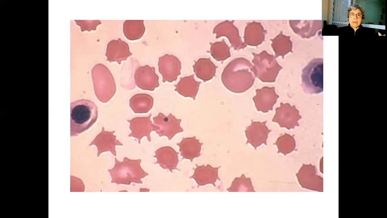 Alterações eritrocitárias aula