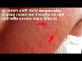 Home Treatment For Chicken Skin Or Small Bumps On The Skin