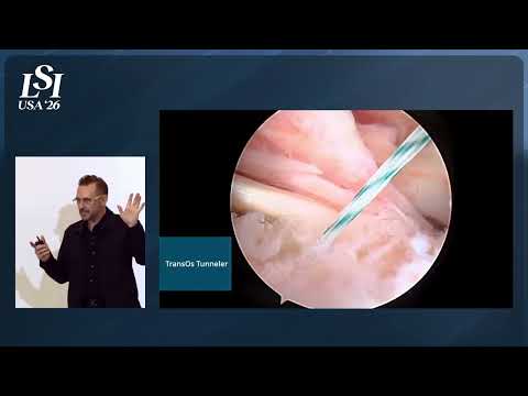 Justin Anderson, Tensor Surgical - Anchorless rotator cuff and biceps repair devices | LSI USA '26