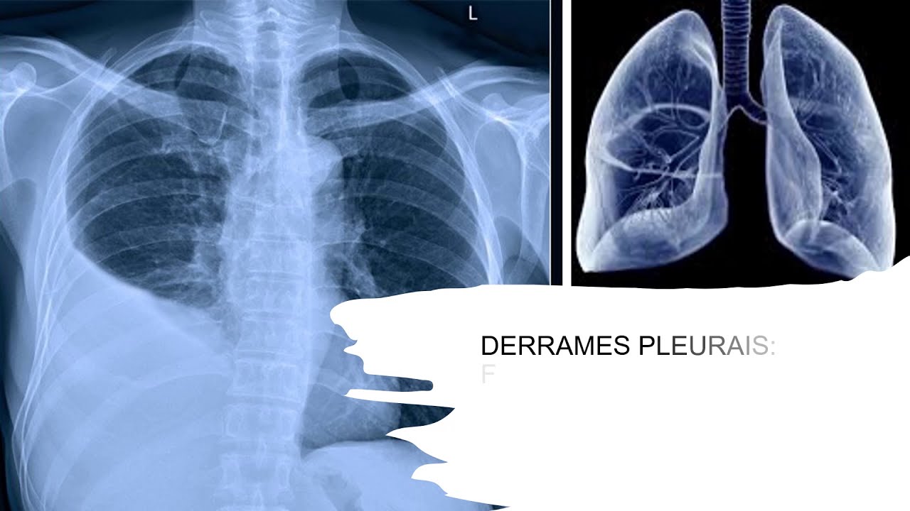 Derrame Pleural: conhecendo o mecanismo fisiopatológico e ações de enfermagem