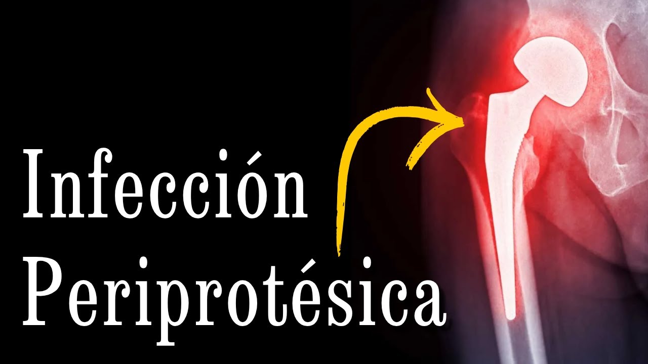 Infección Periprotésica Explicado Claramente