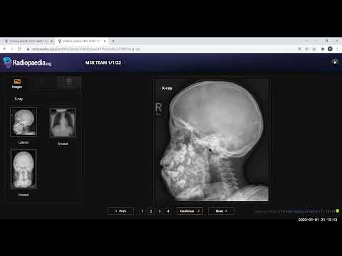 TEAM FRCR 2B Viva Practice Session (MSK Module). 1st Jan, 2022