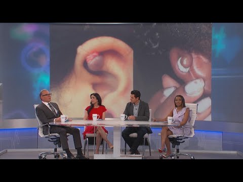 Rubber Bands to Remove Keloids?