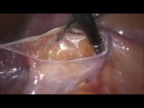 marSeal5 IQ and maXium® – Pelvic lymphadenectomy