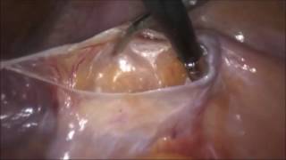 marSeal5 IQ and maXium® | Pelvic lymphadenectomy