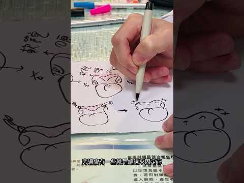 EP17 懸吊式顎咽成形術