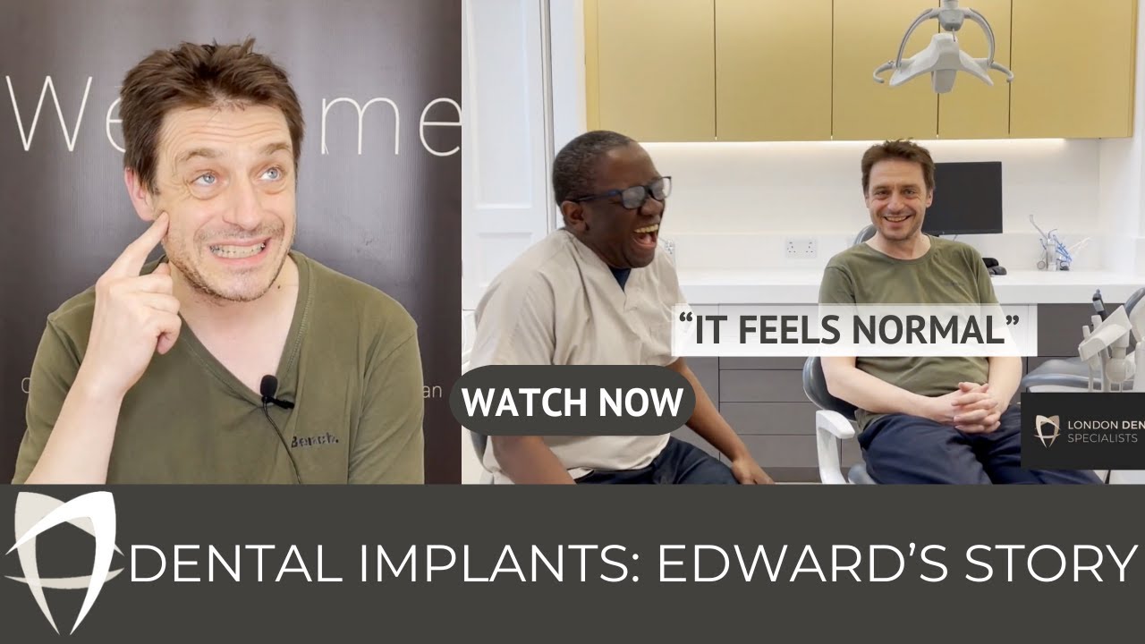 Edward - 3 Implants (UR5, LR5, UL5) with Bone & Gum Grafts