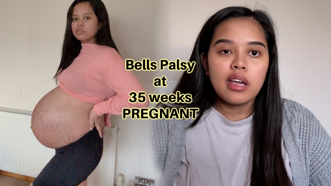 FILIPINA BRITISH LIFE IN UK: DIAGNOSED WITH BELLS PALSY AT 35 WEEKS PREGNANT