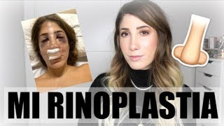 RINOPLASTIA | Mi experiencia con FOTOS | precio | ¿Me dolió | ¿Por qué lo hice