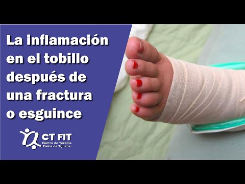 Ankle swelling after a fracture or sprain | Tijuana Physical Therapy Center