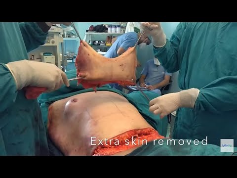 Patient Recovery Case — Video 30 (Body Sculpting)