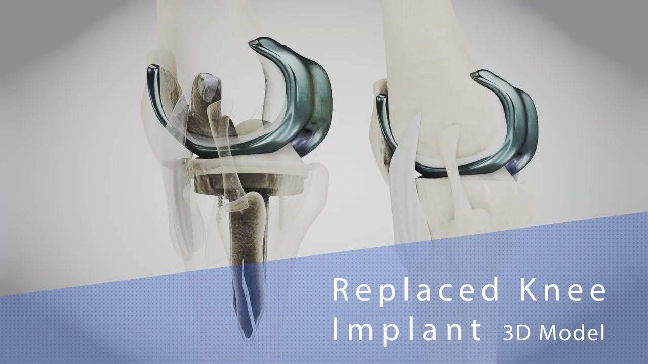 Knie implantaat 3D Model