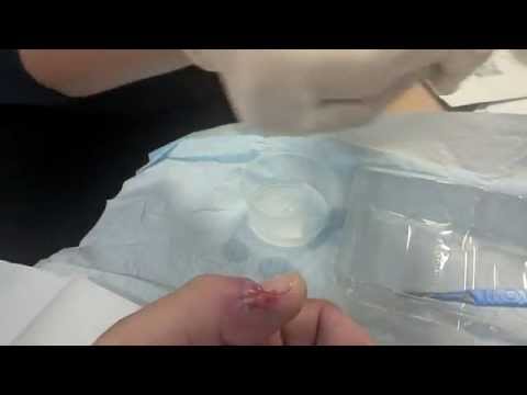 Infected thumb filled with pus treated by kind nurse