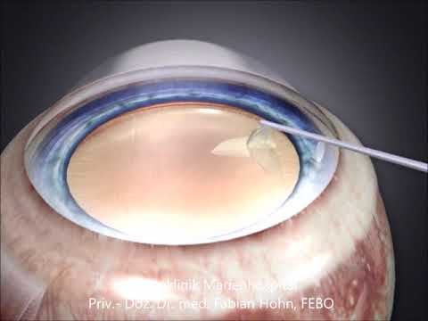 Krankheiten des Auges: Grauer Star