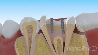 Endodoncia y reconstrucción
