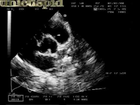 Unicuspid Aortic Valve With Moderate Stenosis And Regurgitation