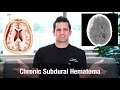 What Is A Chronic Subdural Hematoma