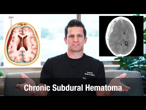 what is a Chronic Subdural Hematoma