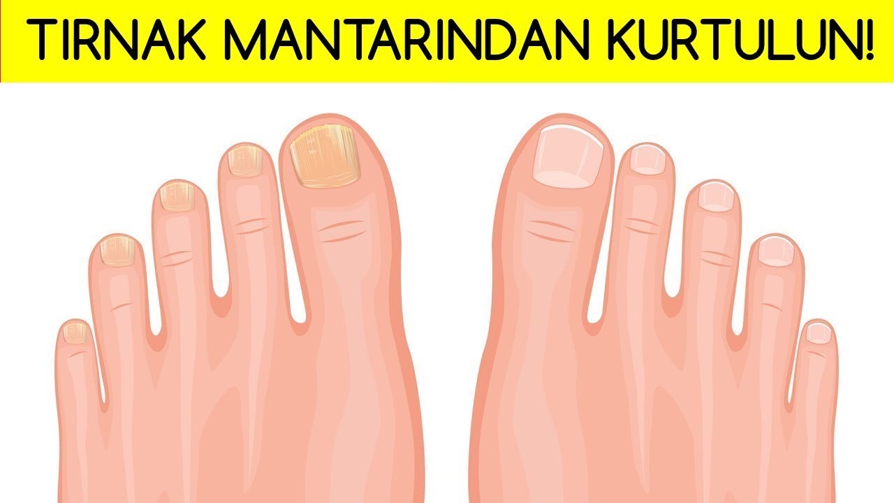 Ayak tırnak mantarına doğal tedaviler Ayak tırnak mantarına doğal tedaviler