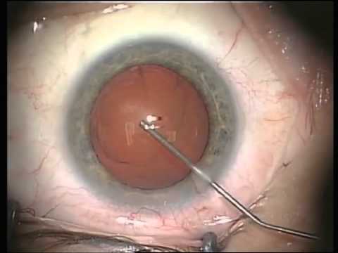 Nowoczesne leczenie zaćmy