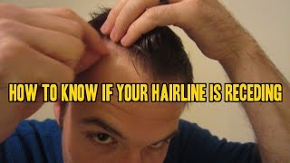 How to Know If Your Hairline is Receding