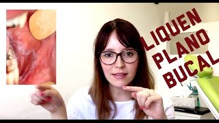 Tips para el diagnóstico de Liquen Plano Bucal