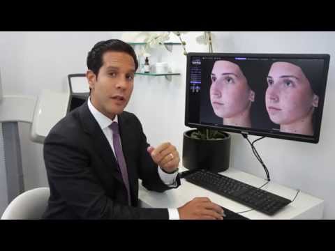 4. 3D Simulation of Rhinoplasty Results