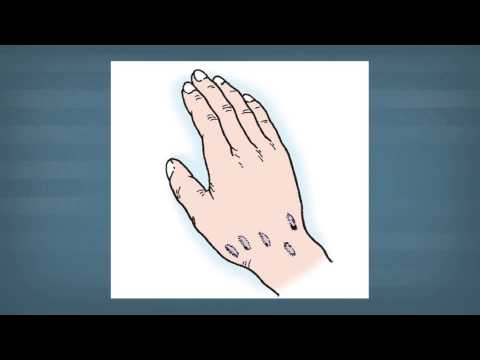 Diagnosing and Possible Treatments for Ganglions Explained by Dr. Thomas Trumble