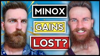 Is my Beard FALLING OUT? | Minoxidil Beard Shedding | Eight Month Yeard Update