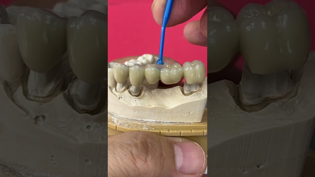 5-Unit Metal Ceramic Bridge