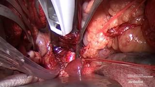 Download Lagu Aorto-Hepatic Bypass Using a Novel Aortic Anastomotic Device Thumbnail