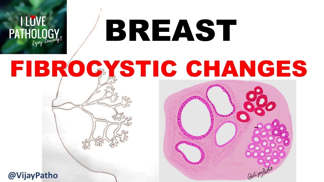 Diseases of Breast: Part 1. Normal anatomy, Classification & FIBROCYSTIC CHANGES