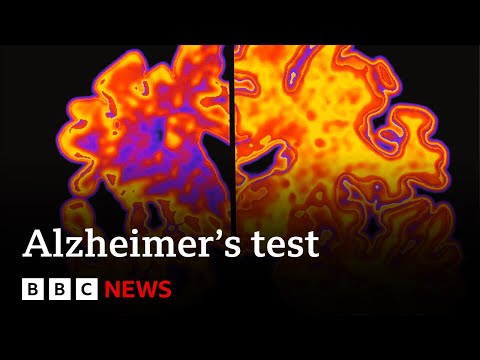 Blood test may revolutionise treatment of Alzheimers disease | BBC News