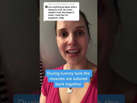 Tummy Tuck for Diastasis Recti | Greer Plastic Surgery