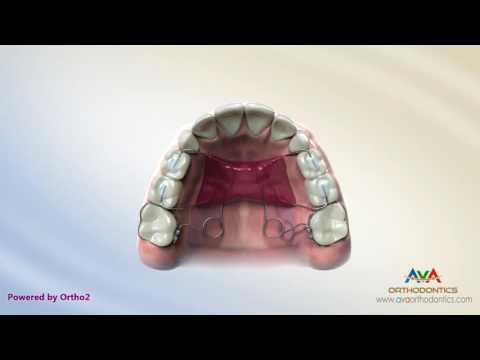 Orthodontic Space Management - Pendulum Appliance