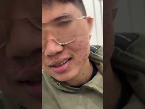 Tình trạng mụn viêm nặng của bạn nam khi tới Bác sĩ da liễu #shorts