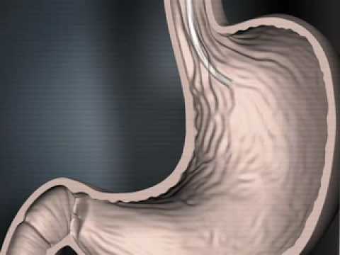 Kimberly-Clark MIC*J/TJ Introducer Kits - Radiologic Placement