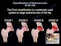Osteonecrosis Of The Hip Ficat Classification - Everything You Need To Know - Dr. Nabil Ebraheim