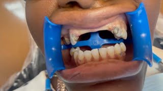 Complete Smile Makeover IN A DAY 🔥🦷👩🏾‍⚕️ Smiles by Dr. Heavenly