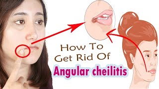 How to Get Rid of Angular Cheilitis Naturally at Home || Home Remedies For Crack Lips