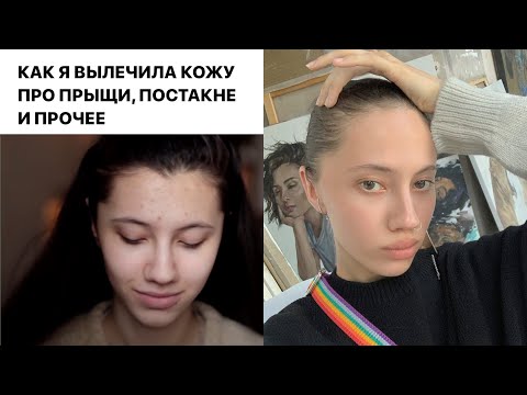 КАК Я ИЗБАВИЛАСЬ ОТ ПРЫЩЕЙ? Мой УХОД за кожей + советы