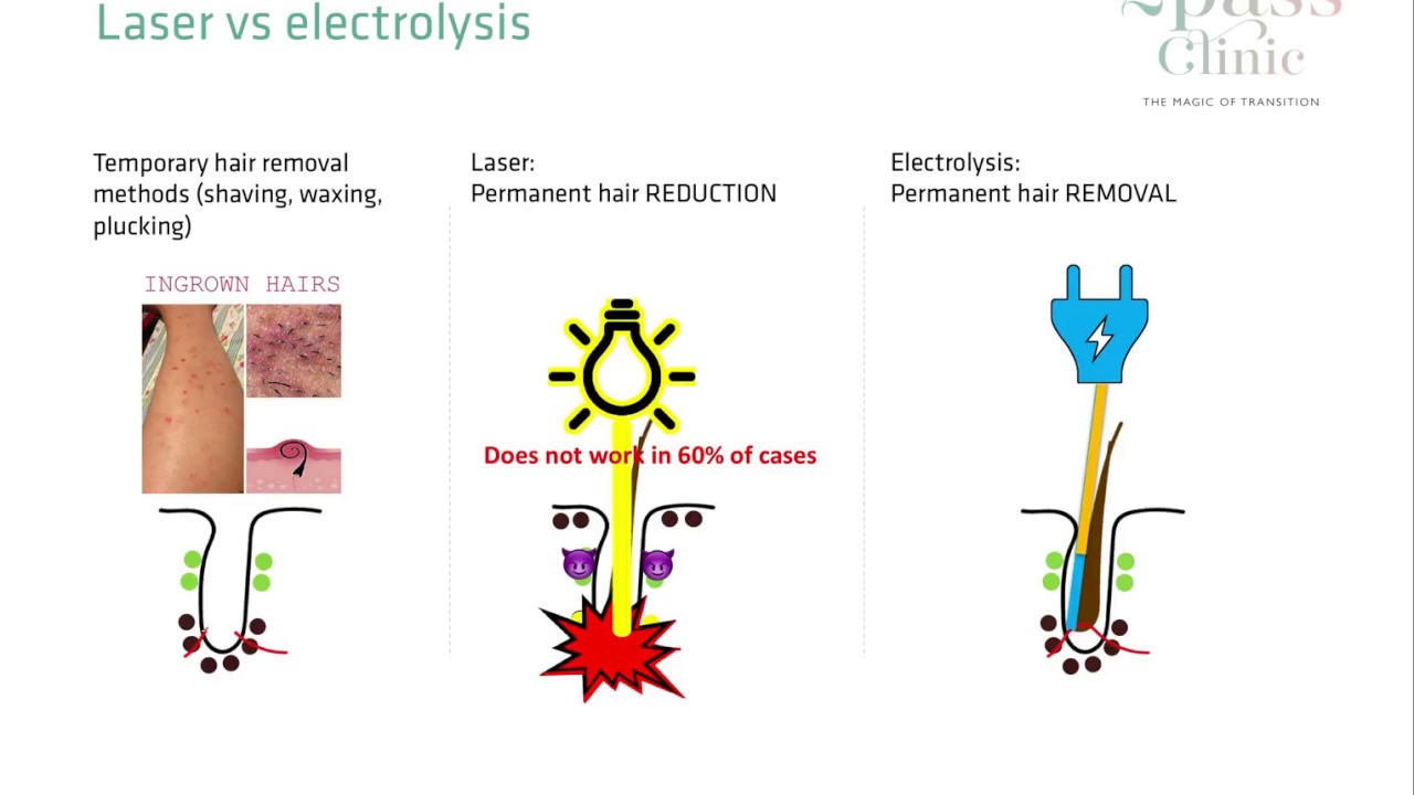 Electrolysis - Laser hair removal vs Electrolysis