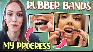 Invisalign Update!
