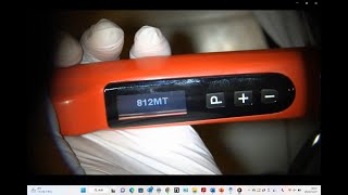 MTA obturation with 812MT in one visit retreatment/812MT(Ai motor kai)による1回法によるMTA根管充填