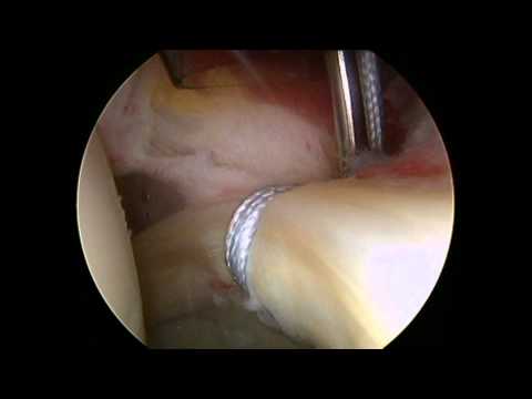 Hip Arthroscopy With Labral Repair