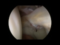 Hip arthroscopy - labral repair 2.0