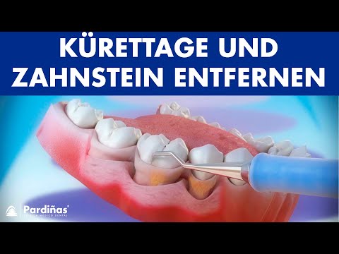 Parodontosebehandlung - Kürettage und Zahnstein entfernen ©