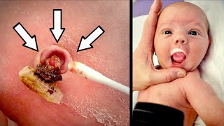 GNARLY UMBILICAL GRANULOMA! (Super Chill Newborn) | Dr. Paul